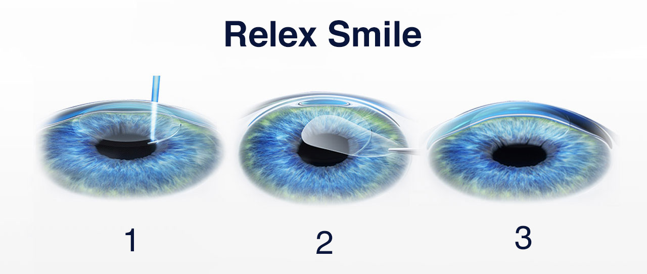 Схема 3 этапов операции SMILE