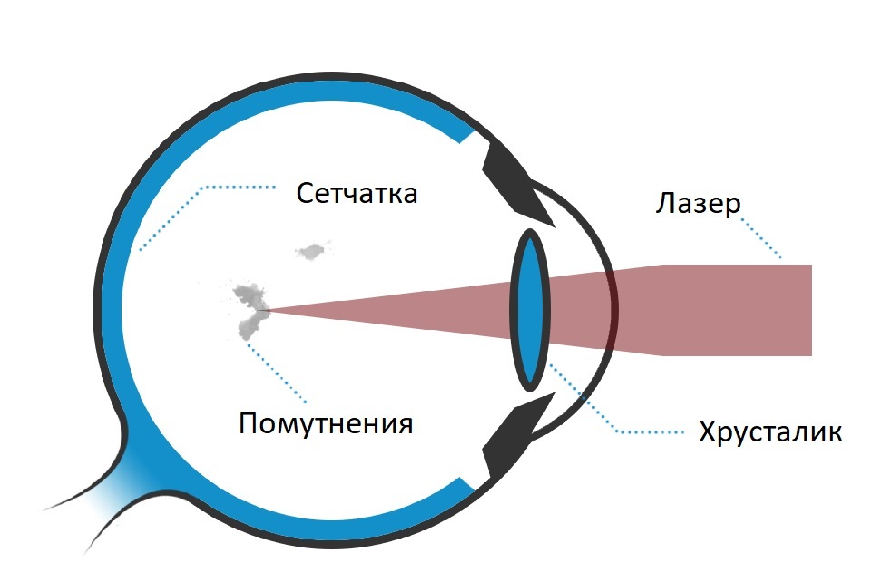Лазерный витреолизис